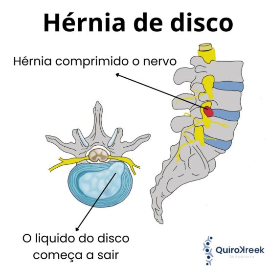Tratamento quiroprático para hérnia de disco